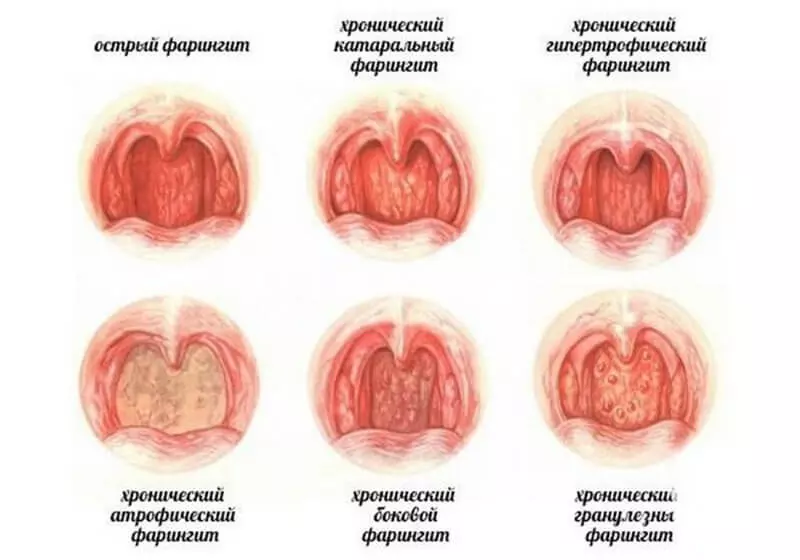 Чем полоскать горло?