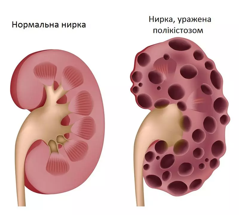 Лечение хронической почечной недостаточности | Ассоциация медицинских центров Израиля