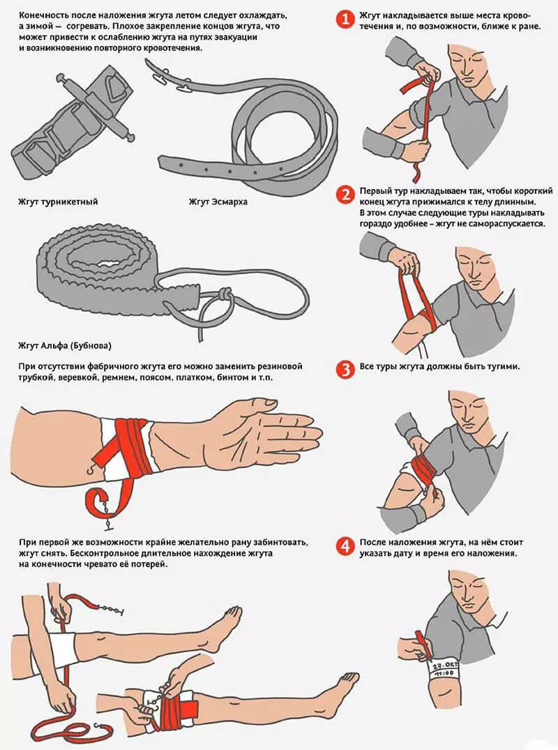 Правила наложения жгута